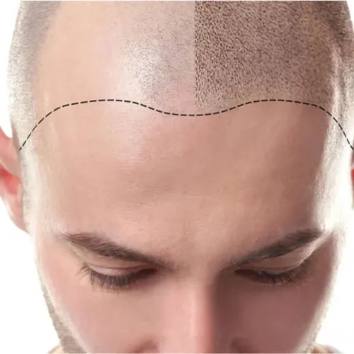 Микроблейдинг кожи головы – процедура, которая помогает с проблемой выпадения волос
