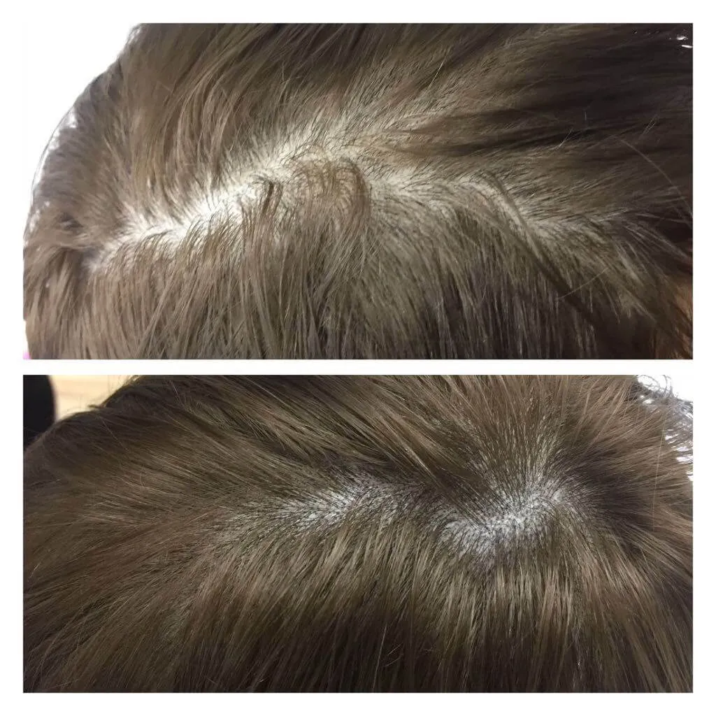 Мікроблейдинг шкіри голови - до та після процедури, результати